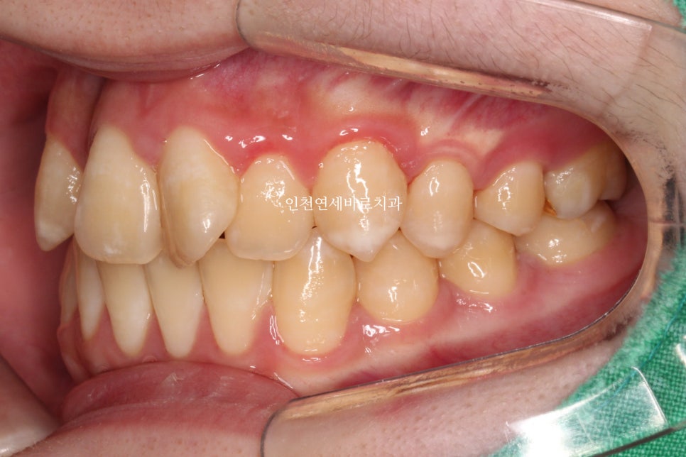 철사교정 끝나고도 비베라 vivera 가능할까?