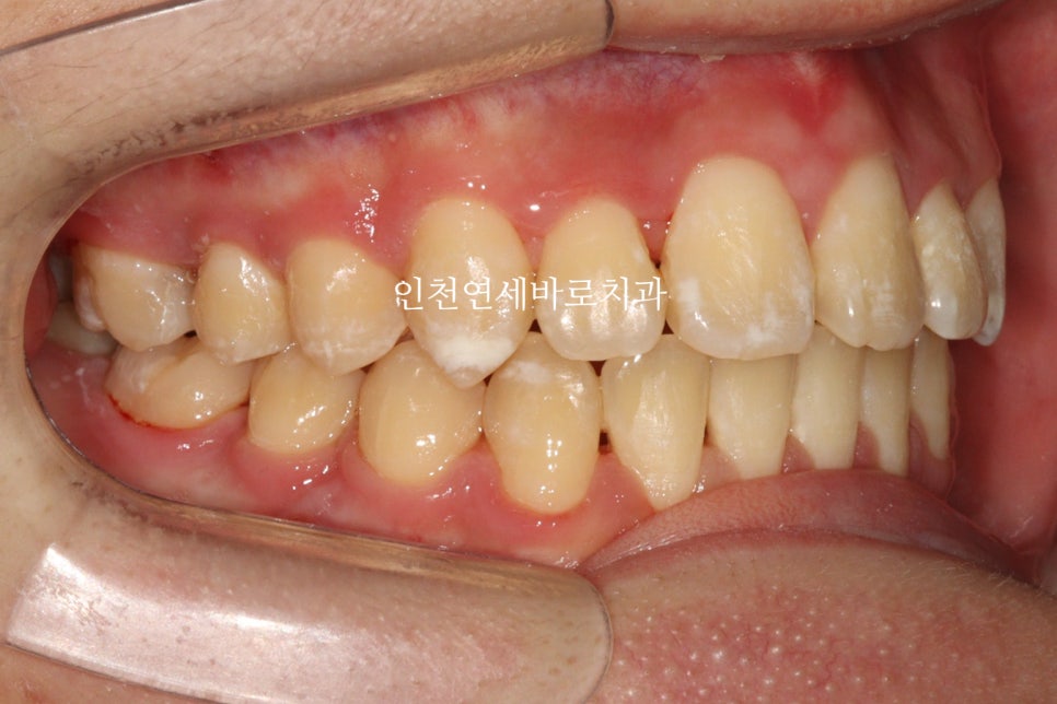 철사교정 끝나고도 비베라 vivera 가능할까?