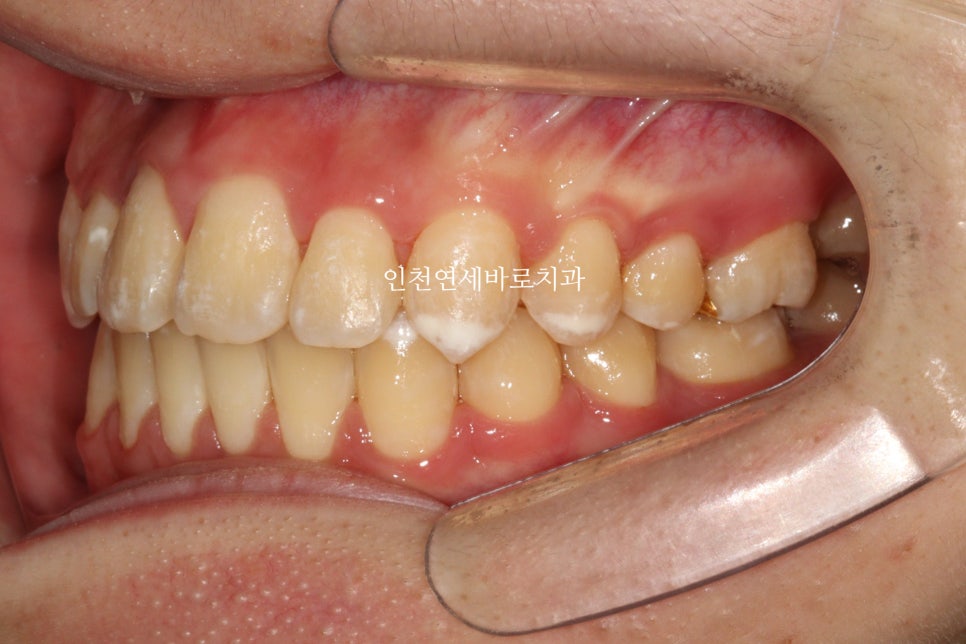 철사교정 끝나고도 비베라 vivera 가능할까?