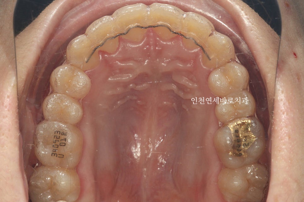 철사교정 끝나고도 비베라 vivera 가능할까?