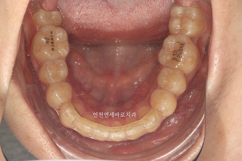 철사교정 끝나고도 비베라 vivera 가능할까?