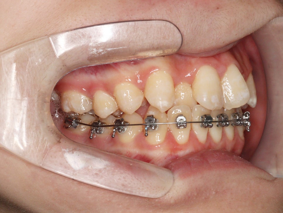 철사교정 끝나고도 비베라 vivera 가능할까?