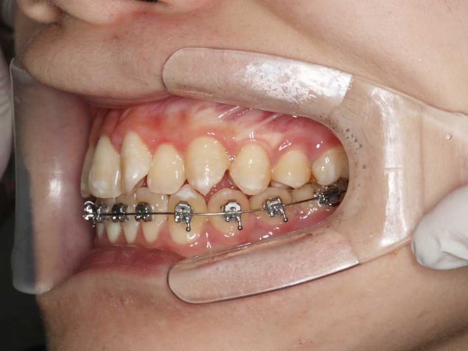 철사교정 끝나고도 비베라 vivera 가능할까?