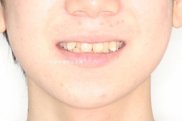 철사교정 끝나고도 비베라 vivera 가능할까?