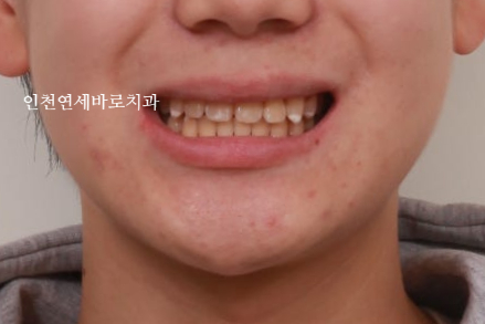 철사교정 끝나고도 비베라 vivera 가능할까?