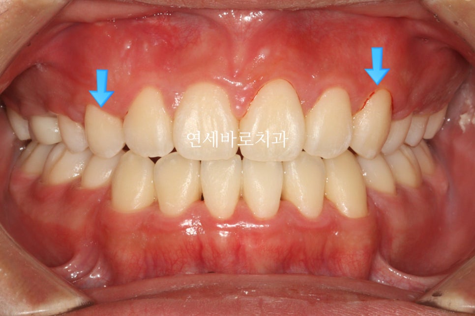 매복 송곳니를 굳이 원위치 시켜야할까 발치하면 어떨까