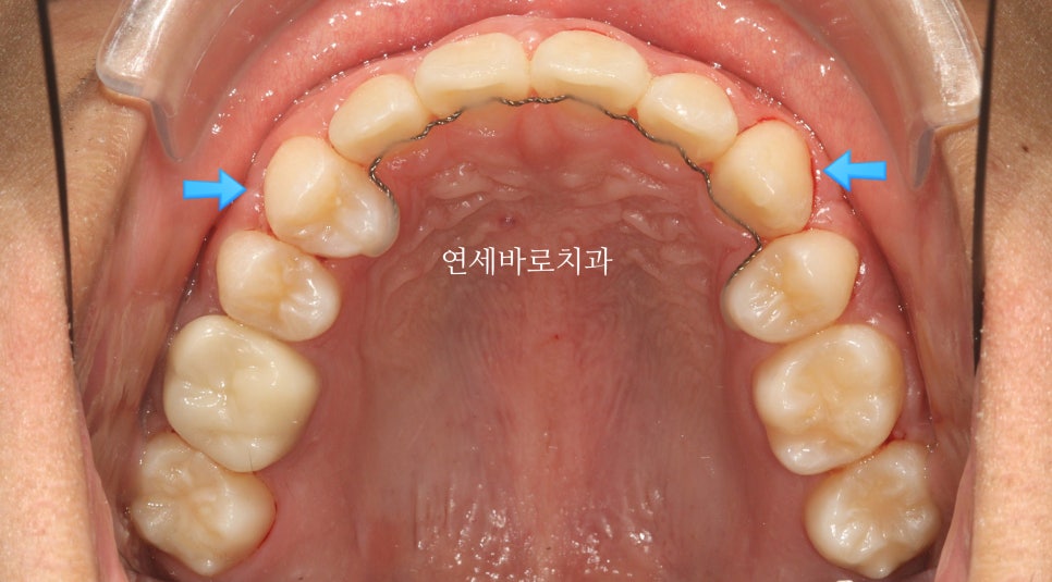 매복 송곳니를 굳이 원위치 시켜야할까 발치하면 어떨까