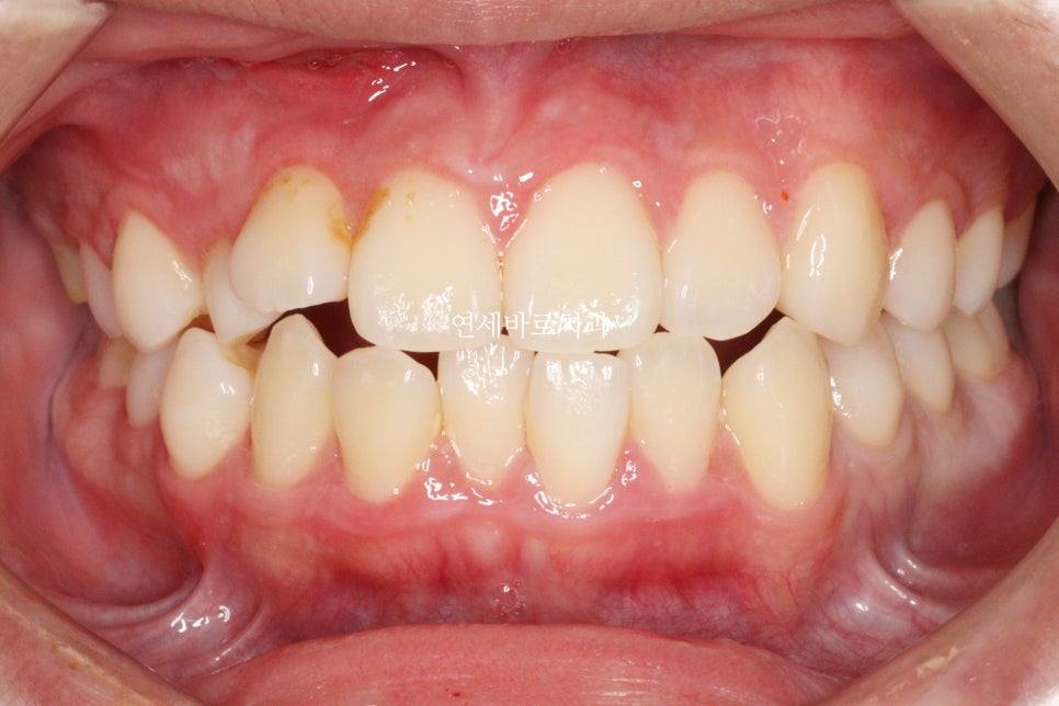 매복 송곳니를 굳이 원위치 시켜야할까 발치하면 어떨까