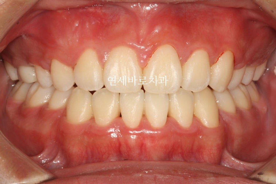 매복 송곳니를 굳이 원위치 시켜야할까 발치하면 어떨까
