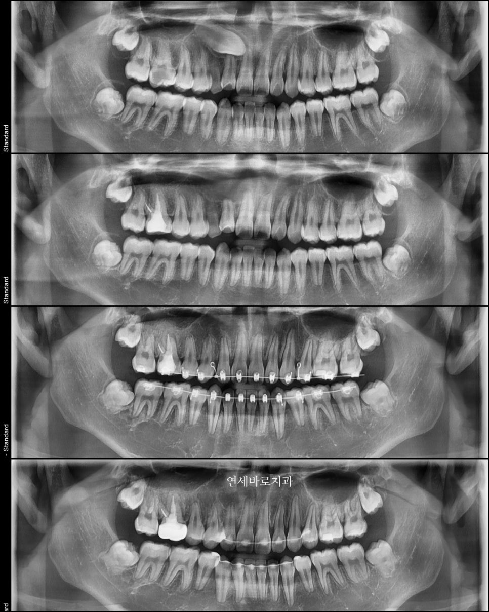 매복 송곳니를 굳이 원위치 시켜야할까 발치하면 어떨까