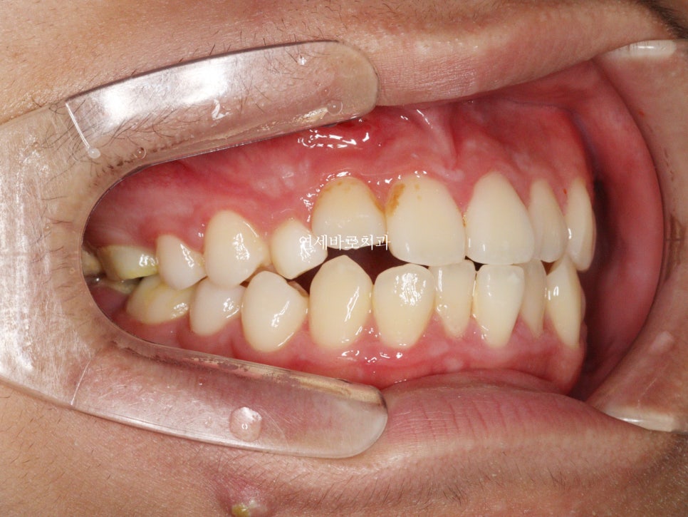 매복 송곳니를 굳이 원위치 시켜야할까 발치하면 어떨까