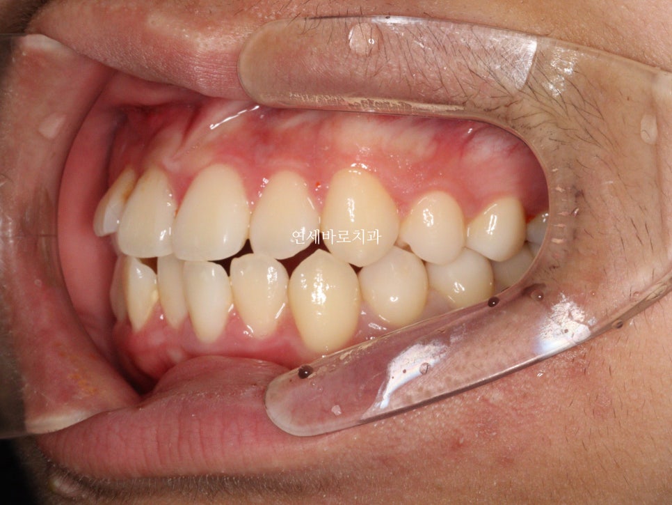 매복 송곳니를 굳이 원위치 시켜야할까 발치하면 어떨까