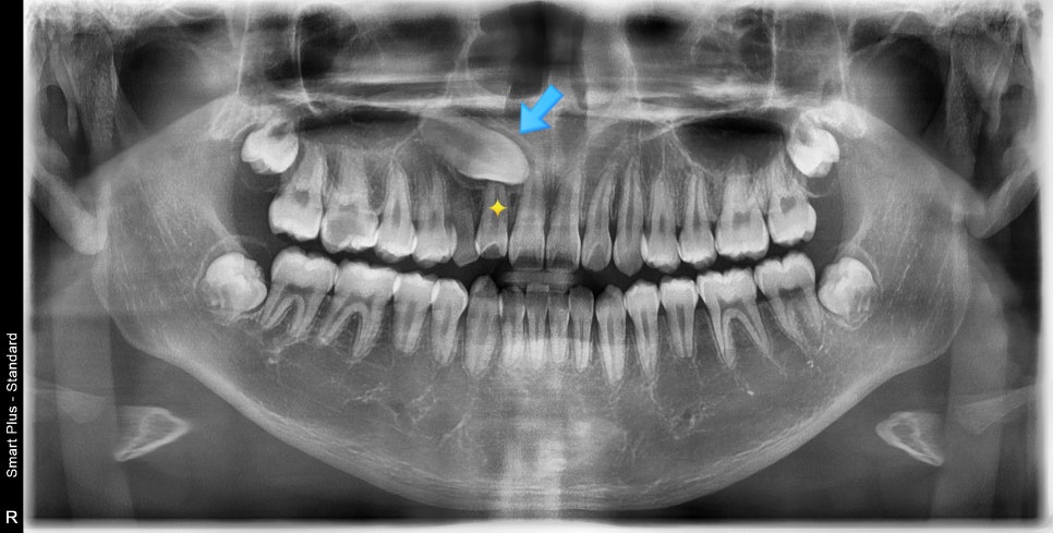 매복 송곳니를 굳이 원위치 시켜야할까 발치하면 어떨까