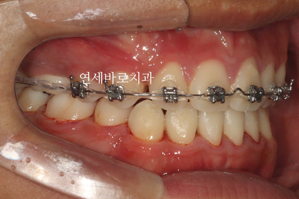 매복 송곳니를 굳이 원위치 시켜야할까 발치하면 어떨까