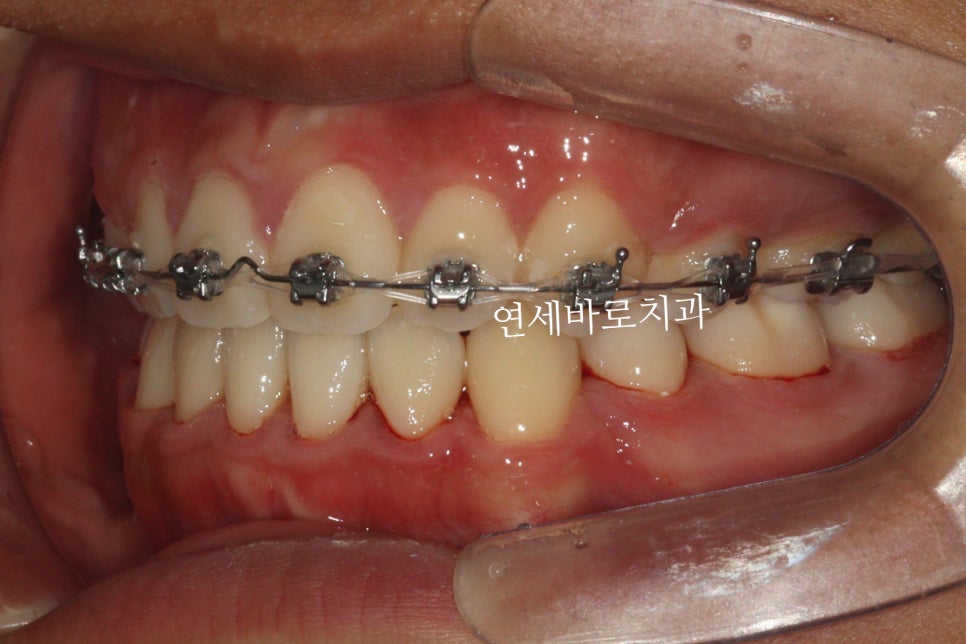 매복 송곳니를 굳이 원위치 시켜야할까 발치하면 어떨까