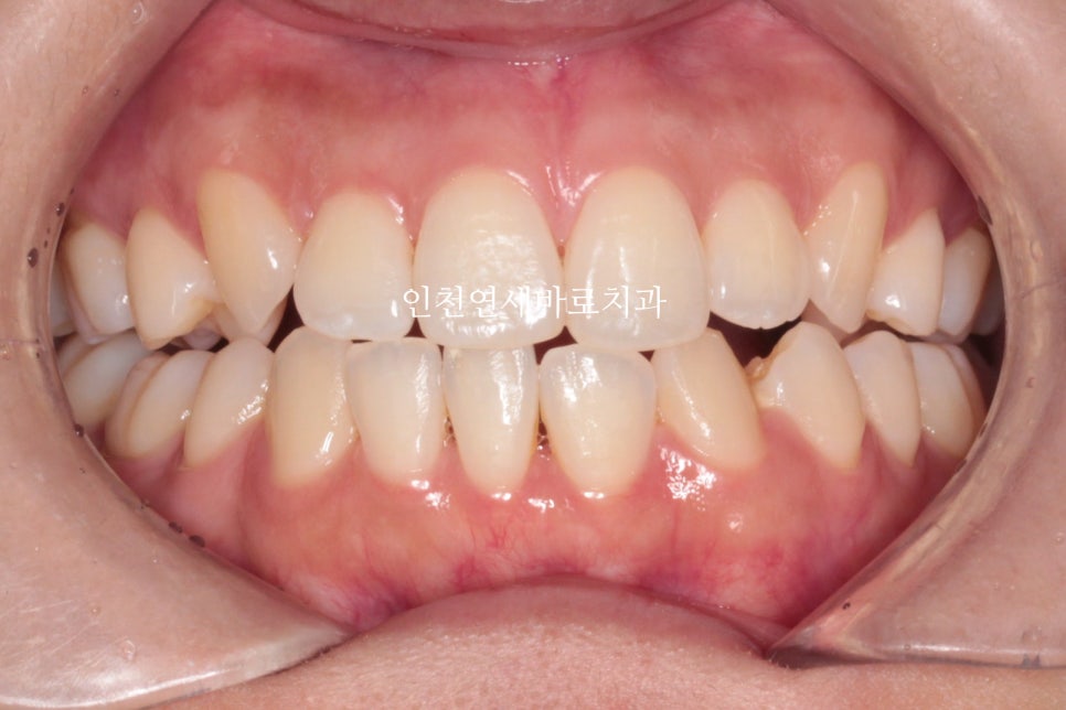 인비절라인 치료 중간에 클리피씨로 바꾼 (실패?) 첫번째 환자분 치료이야기