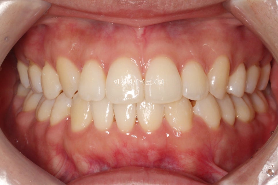 인비절라인 치료 중간에 클리피씨로 바꾼 (실패?) 첫번째 환자분 치료이야기