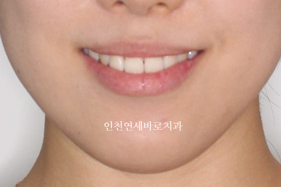 인비절라인 치료 중간에 클리피씨로 바꾼 (실패?) 첫번째 환자분 치료이야기