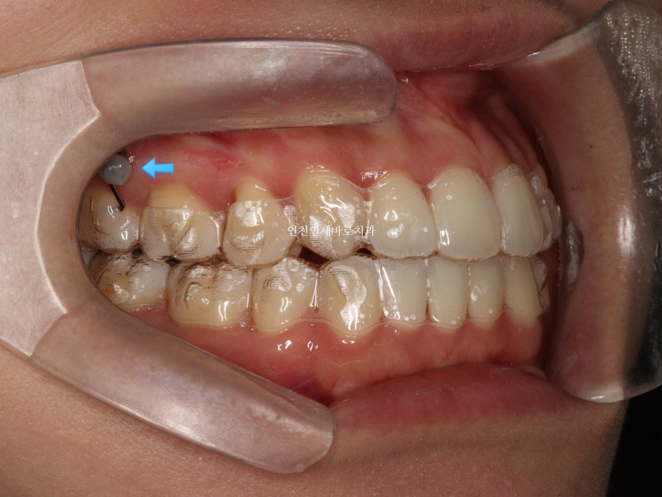인비절라인 치료 중간에 클리피씨로 바꾼 (실패?) 첫번째 환자분 치료이야기