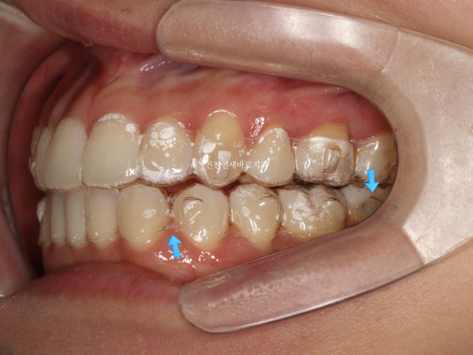 인비절라인 치료 중간에 클리피씨로 바꾼 (실패?) 첫번째 환자분 치료이야기