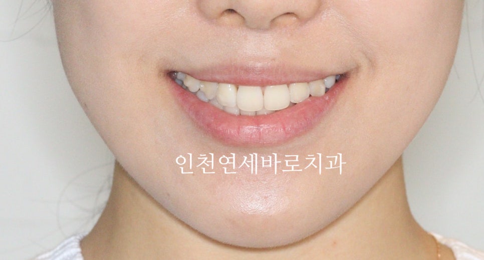 인비절라인 치료 중간에 클리피씨로 바꾼 (실패?) 첫번째 환자분 치료이야기