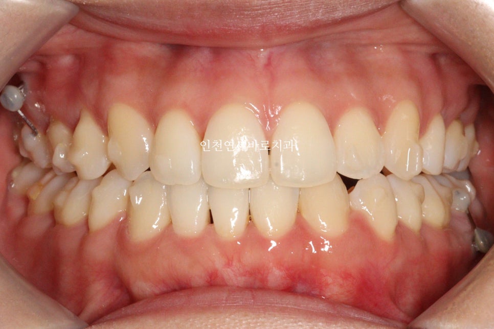 인비절라인 치료 중간에 클리피씨로 바꾼 (실패?) 첫번째 환자분 치료이야기