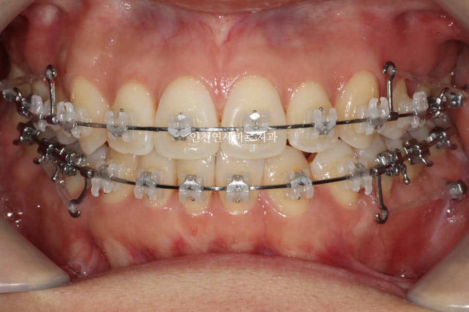 인비절라인 치료 중간에 클리피씨로 바꾼 (실패?) 첫번째 환자분 치료이야기