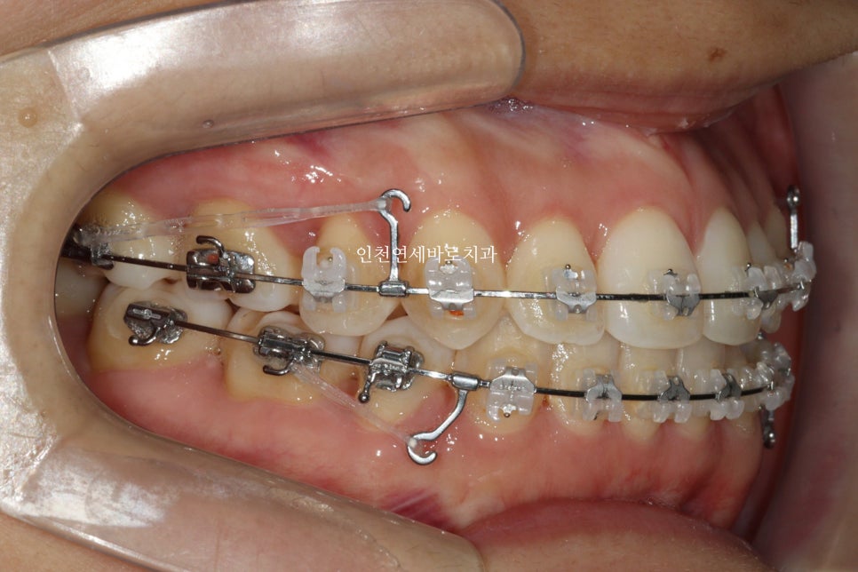 인비절라인 치료 중간에 클리피씨로 바꾼 (실패?) 첫번째 환자분 치료이야기