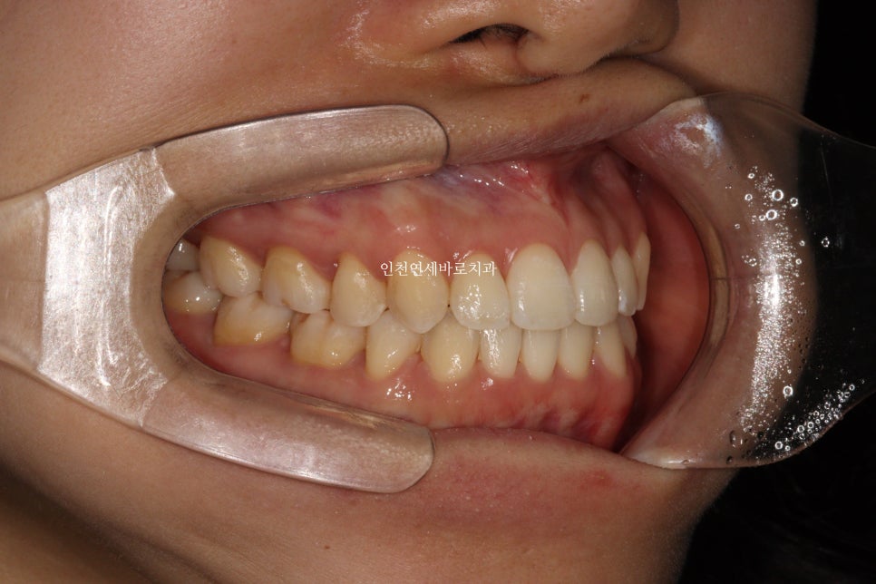 인비절라인 치료 중간에 클리피씨로 바꾼 (실패?) 첫번째 환자분 치료이야기