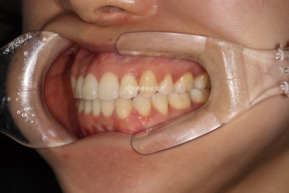 인비절라인 치료 중간에 클리피씨로 바꾼 (실패?) 첫번째 환자분 치료이야기