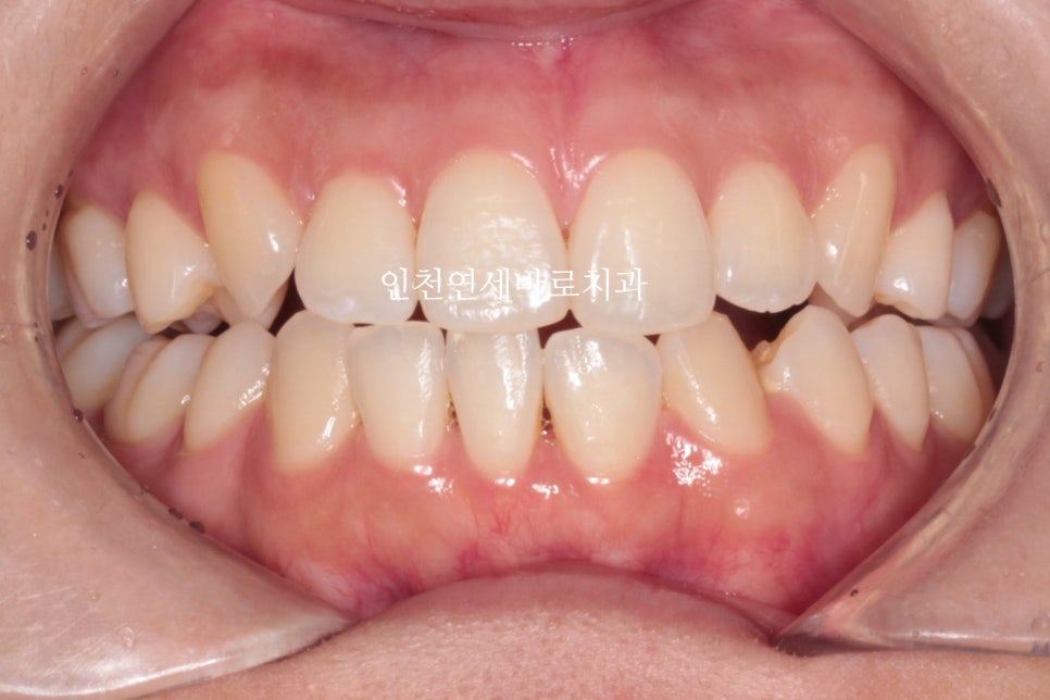 인비절라인 치료 중간에 클리피씨로 바꾼 (실패?) 첫번째 환자분 치료이야기