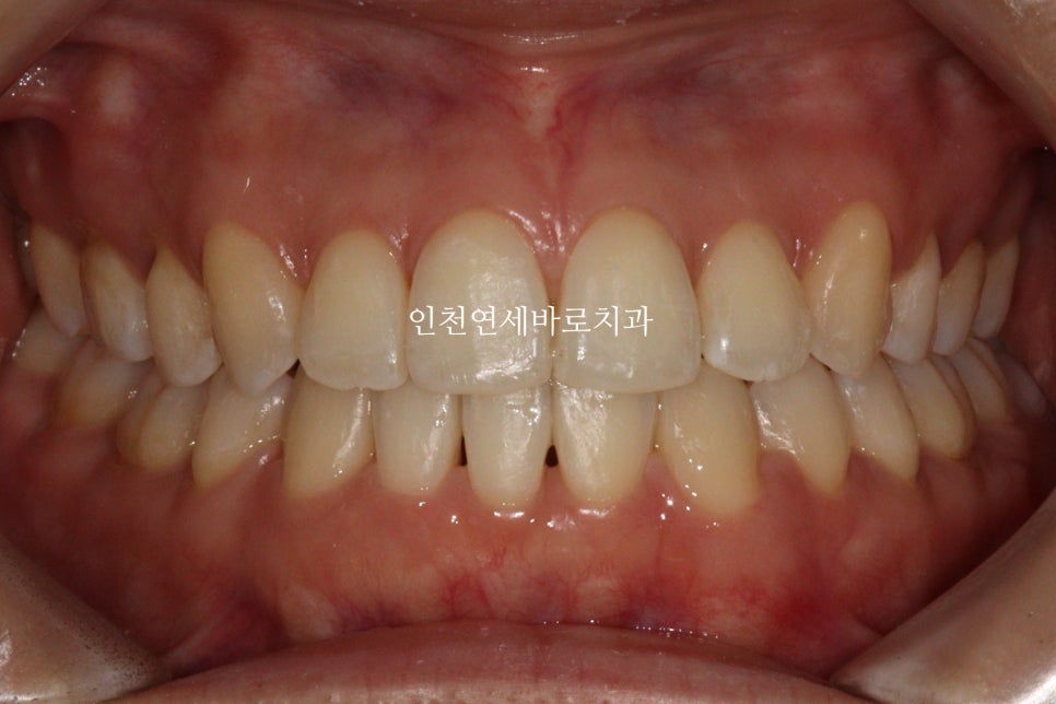 인비절라인 치료 중간에 클리피씨로 바꾼 (실패?) 첫번째 환자분 치료이야기