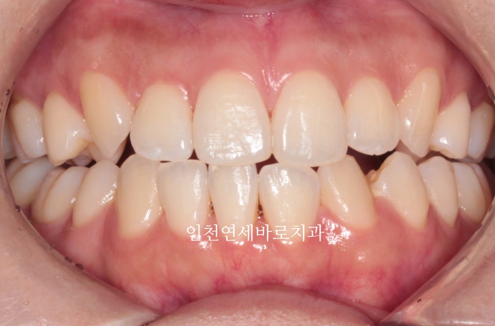 인비절라인 치료 중간에 클리피씨로 바꾼 (실패?) 첫번째 환자분 치료이야기