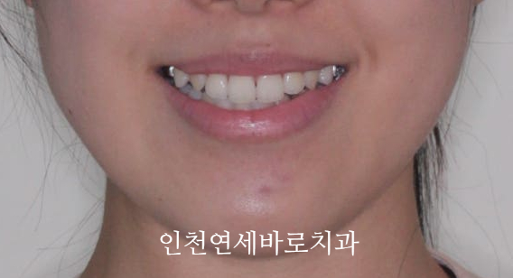 인비절라인 치료 중간에 클리피씨로 바꾼 (실패?) 첫번째 환자분 치료이야기