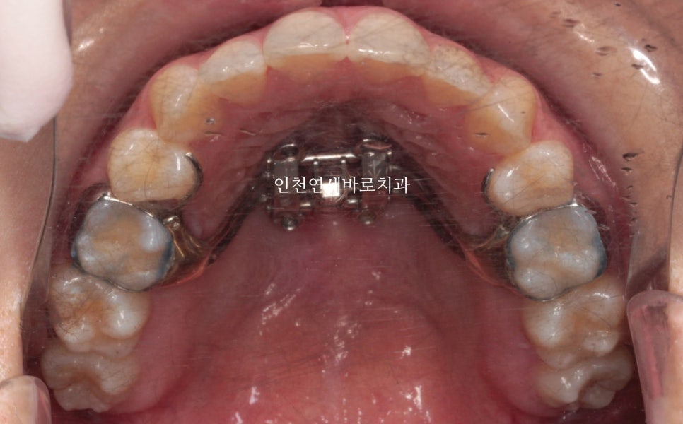 인비절라인 치료 중간에 클리피씨로 바꾼 (실패?) 첫번째 환자분 치료이야기