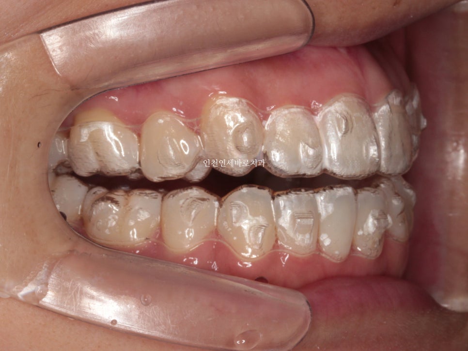 인비절라인 치료 중간에 클리피씨로 바꾼 (실패?) 첫번째 환자분 치료이야기