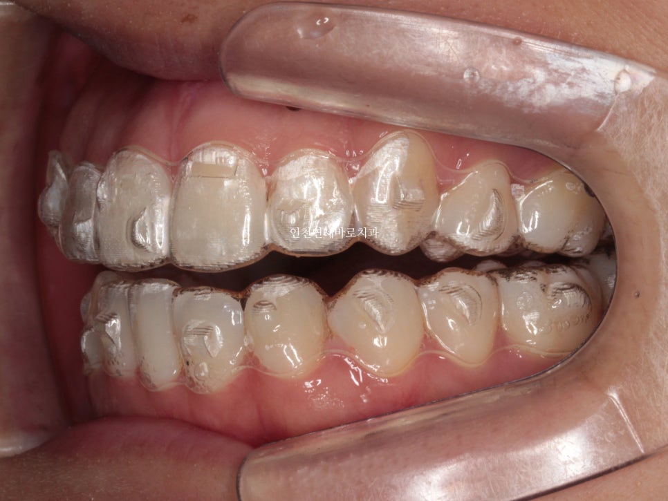 인비절라인 치료 중간에 클리피씨로 바꾼 (실패?) 첫번째 환자분 치료이야기