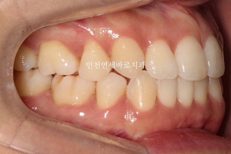 인비절라인 치료 중간에 클리피씨로 바꾼 (실패?) 첫번째 환자분 치료이야기