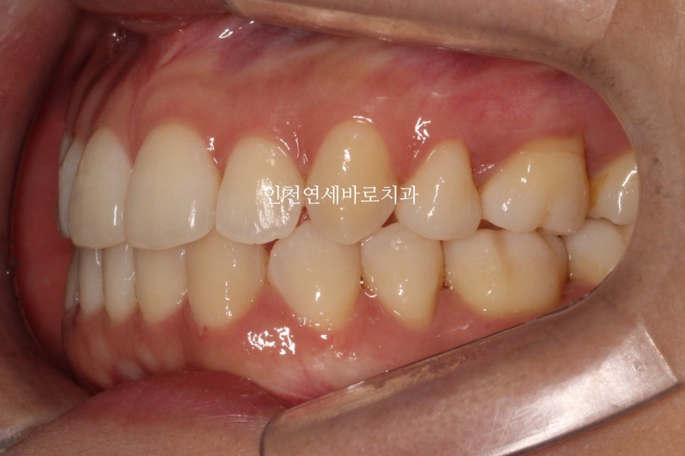 인비절라인 치료 중간에 클리피씨로 바꾼 (실패?) 첫번째 환자분 치료이야기
