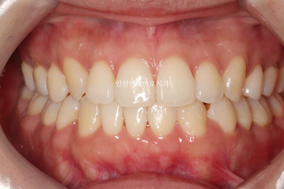 인비절라인 치료 중간에 클리피씨로 바꾼 (실패?) 첫번째 환자분 치료이야기