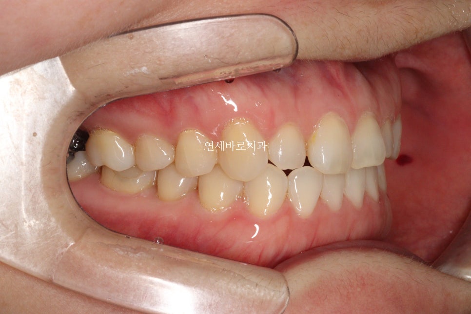 무삭제라미네이트 젤라미, 그리고 인비절라인 라이트 조합