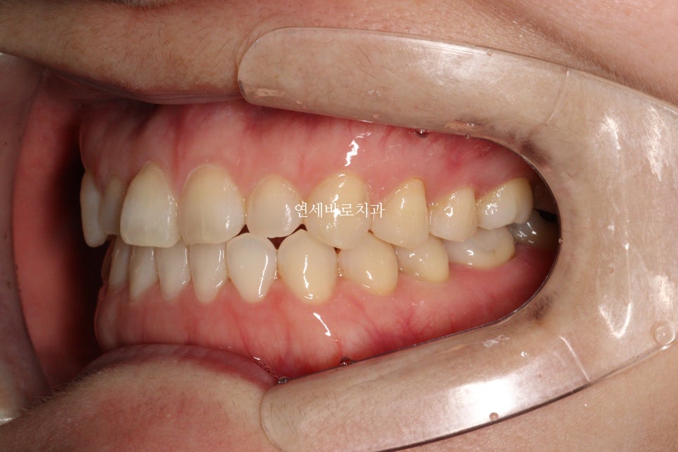 무삭제라미네이트 젤라미, 그리고 인비절라인 라이트 조합