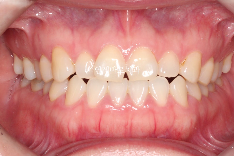 무삭제라미네이트 젤라미, 그리고 인비절라인 라이트 조합