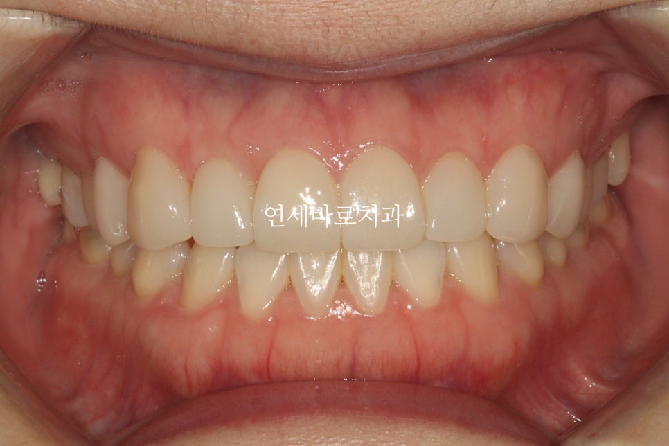 무삭제라미네이트 젤라미, 그리고 인비절라인 라이트 조합