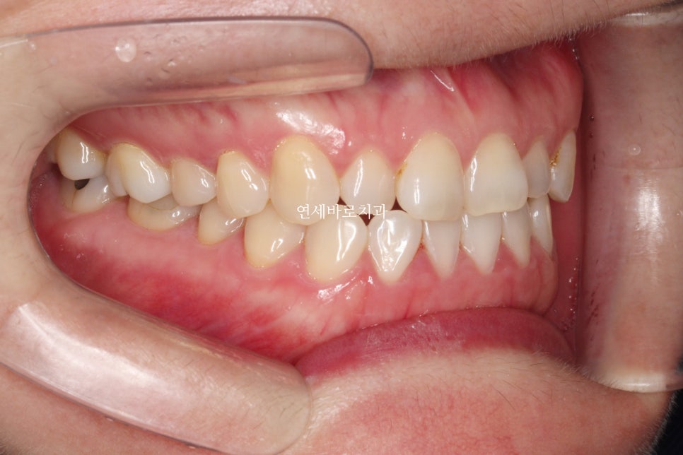 무삭제라미네이트 젤라미, 그리고 인비절라인 라이트 조합