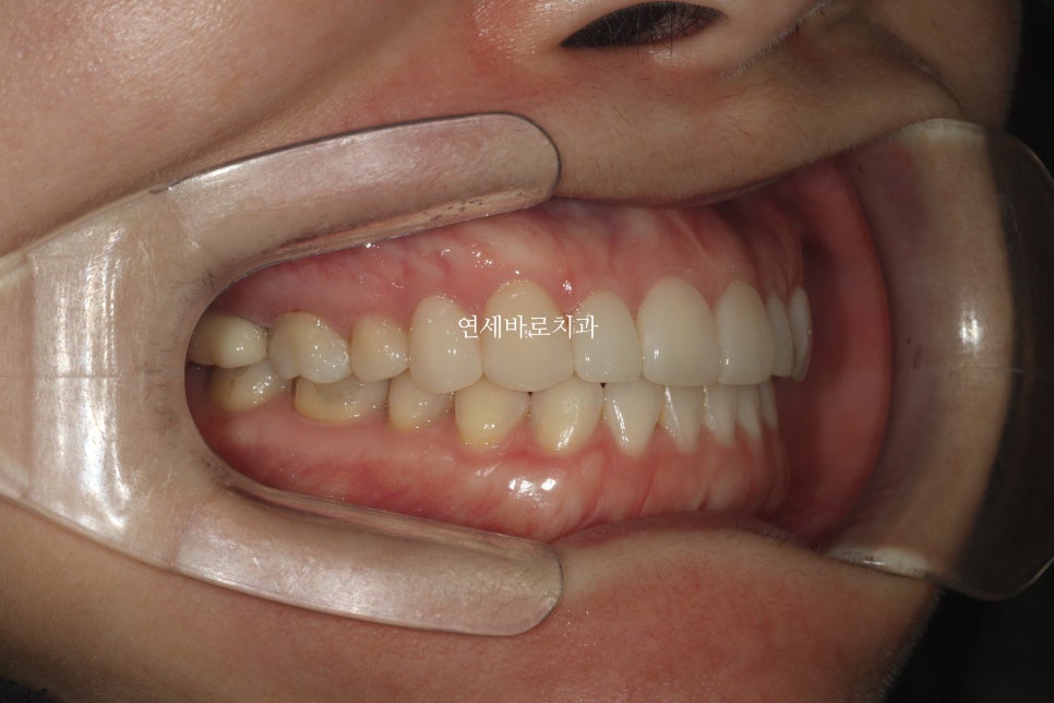 무삭제라미네이트 젤라미, 그리고 인비절라인 라이트 조합