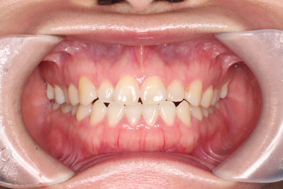 무삭제라미네이트 젤라미, 그리고 인비절라인 라이트 조합