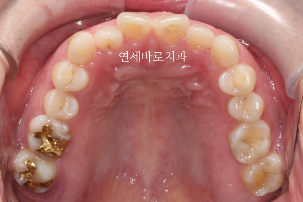 무삭제라미네이트 젤라미, 그리고 인비절라인 라이트 조합