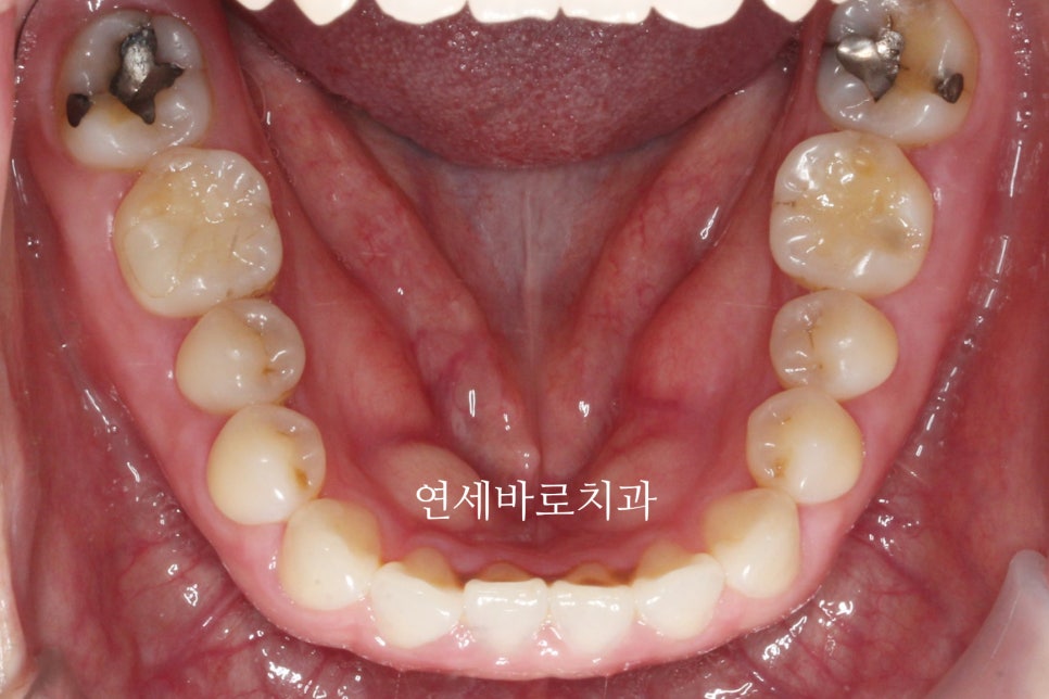 무삭제라미네이트 젤라미, 그리고 인비절라인 라이트 조합