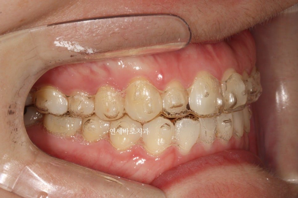 무삭제라미네이트 젤라미, 그리고 인비절라인 라이트 조합